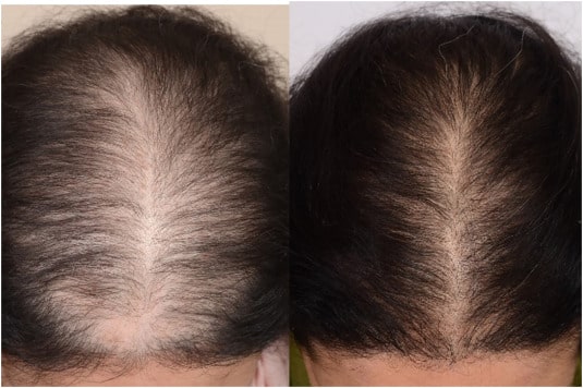 Hair fall Treatment